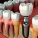 The Benefits of Choosing Dental Implants in Canary Wharf