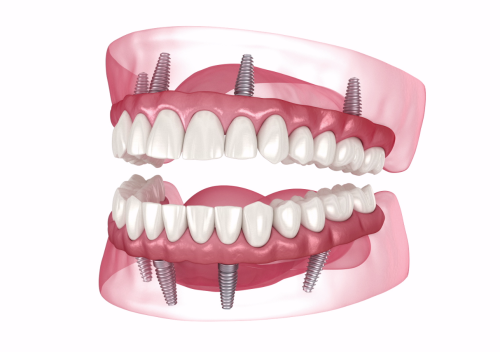 Revolutionising Smiles with Cutting-Edge Implant Technology