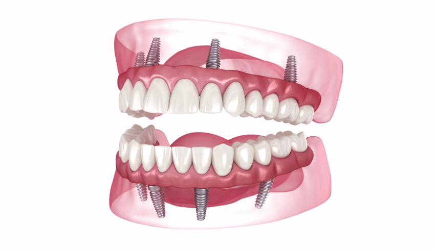 Revolutionising Smiles with Cutting-Edge Implant Technology