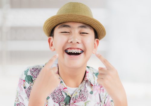 Veneers: Pioneering a New Era of Dental Minimalism
