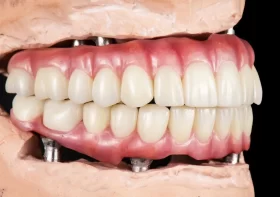 Crafting Natural Smiles: The Artistry of Dental Implant Integration