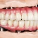 Crafting Natural Smiles: The Artistry of Dental Implant Integration