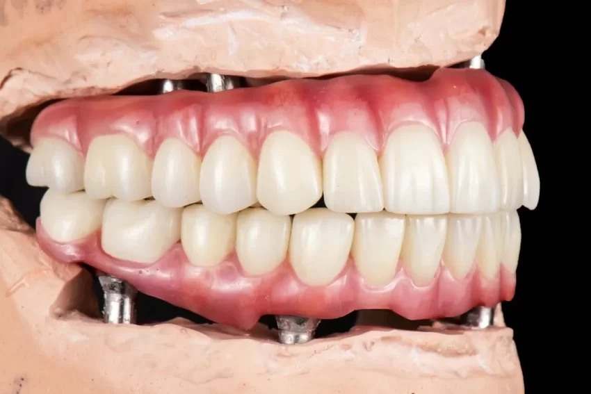 Crafting Natural Smiles: The Artistry of Dental Implant Integration